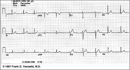 ecg-normal.png