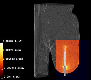 leg implant