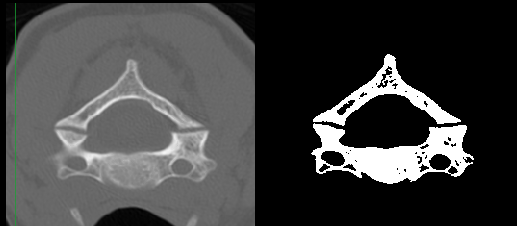 cervical fig1