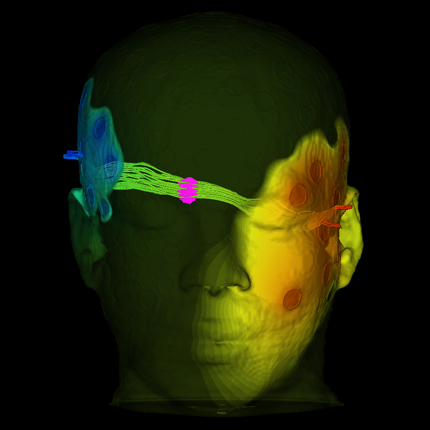 BrainStimulator is a set of networks that are used in SCIRun to perform simulations of brain stimulation such as transcranial direct current stimulation (tDCS) and magnetic transcranial stimulation (TMS).