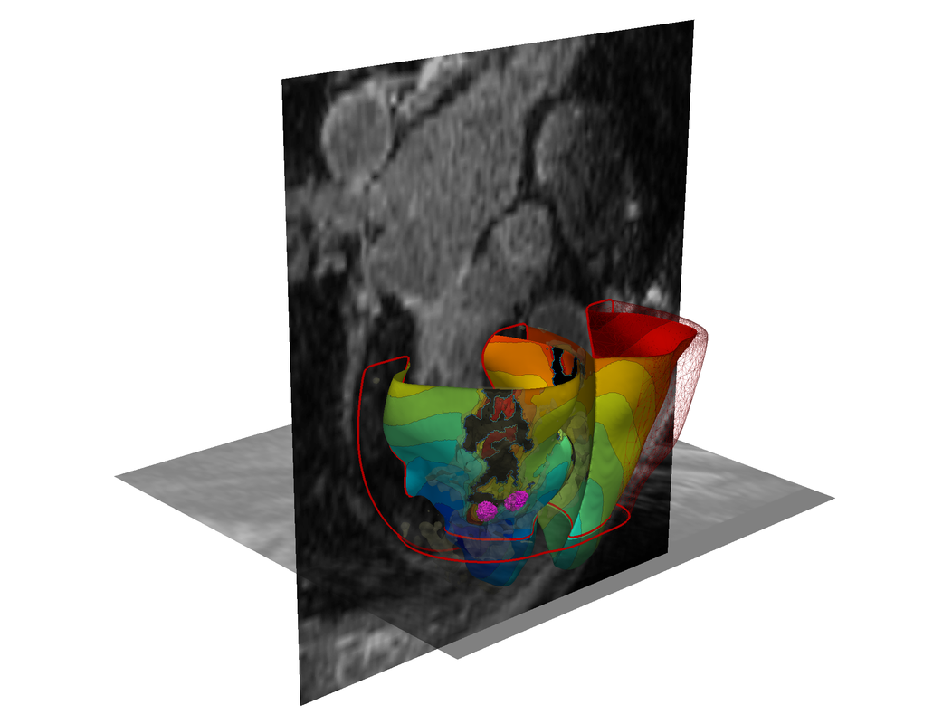 Trayanova Predicting Ablation Targets 2 pyramid
