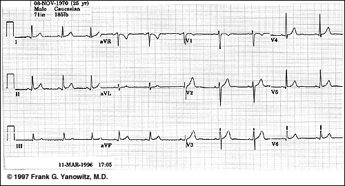 ecg-normal.jpg